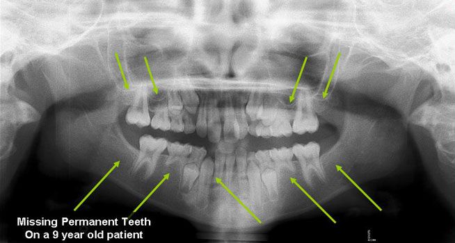 X-ray of missing teeth